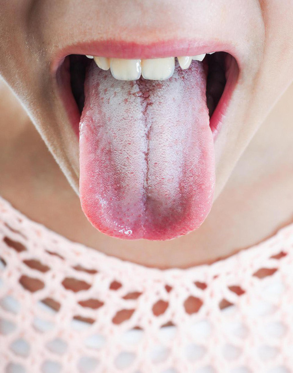 Lưỡi có lớp phủ màu trắng hoặc đốm trắng - dấu hiệu của bệnh Leukoplakia.